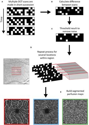 Optical Coherence Tomography Angiography (OCTA) in Multiple Sclerosis and Neuromyelitis Optica Spectrum Disorder